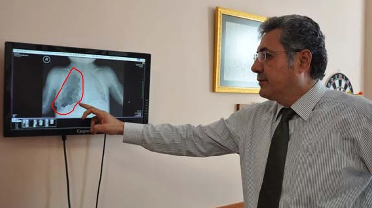 10 aylık bebeğin akciğerinden çıkan parça şoke etti