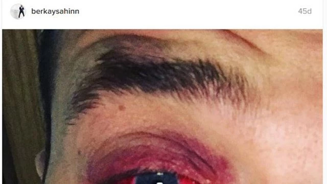 Berkay sağlık problemi `Göz Sağlığının önemini` gündeme getirdi