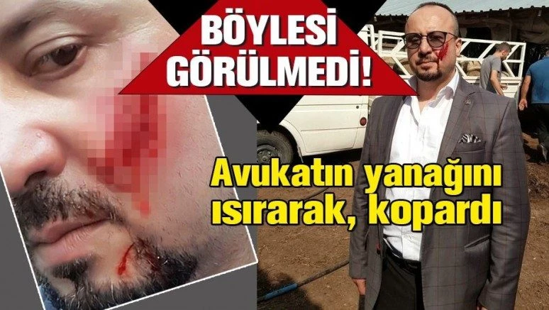 Borçlu icra takibi yapan avukatın yanağını ısırarak kopardı