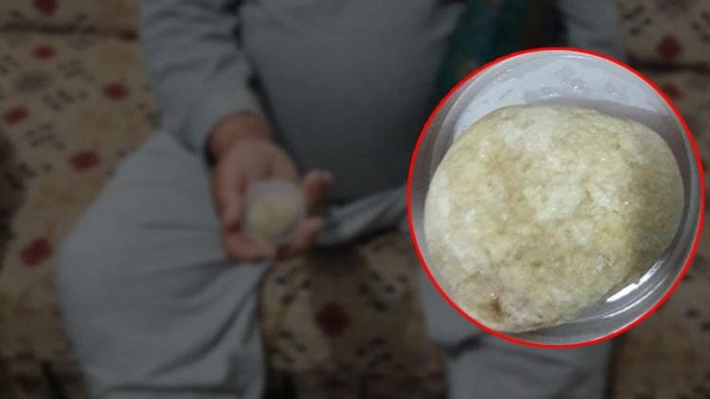 HEPSİ MESANESİNDEN ÇIKTI
