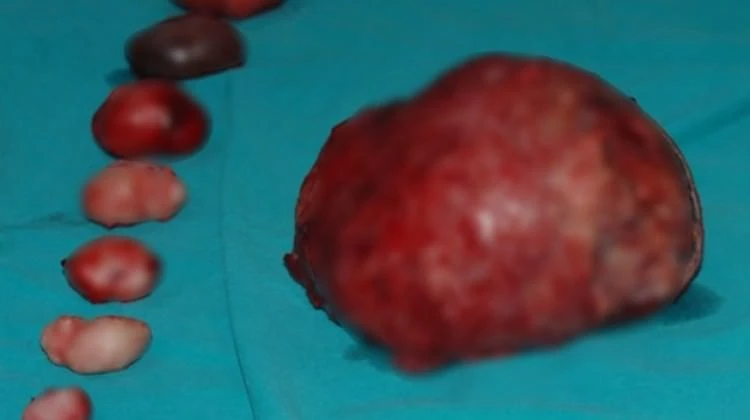 Rahminden 11 tane miyom çıkarıldı