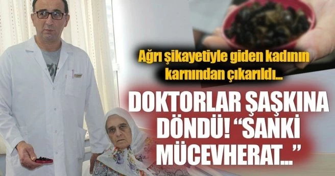 Safra kesesinden çıkan taşlar doktorları bile şaşkına çevirdi