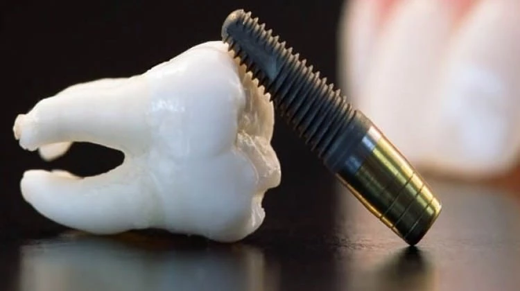 Titanyum implantlar kanser yapıyor mu?