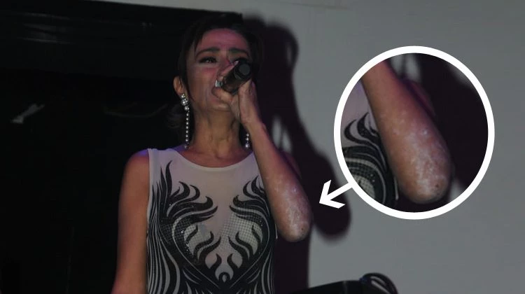 Yıldız Tilbe'nin üzen görüntüsü! Tüm kolları...