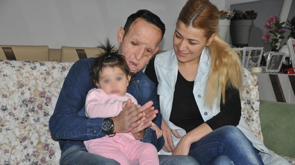 Yüz nakli olan Recep Sert tahliye edildi